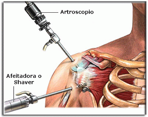 Arttroscopia