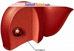 Hemangioma hepático