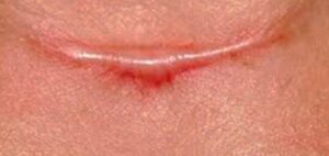 Queloide